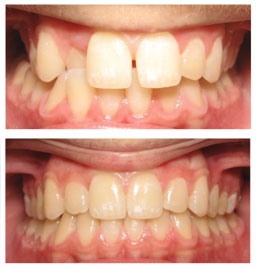 invisalign case before and after