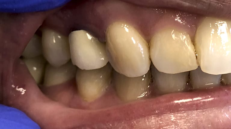 Before Life-Like Crown Benefits