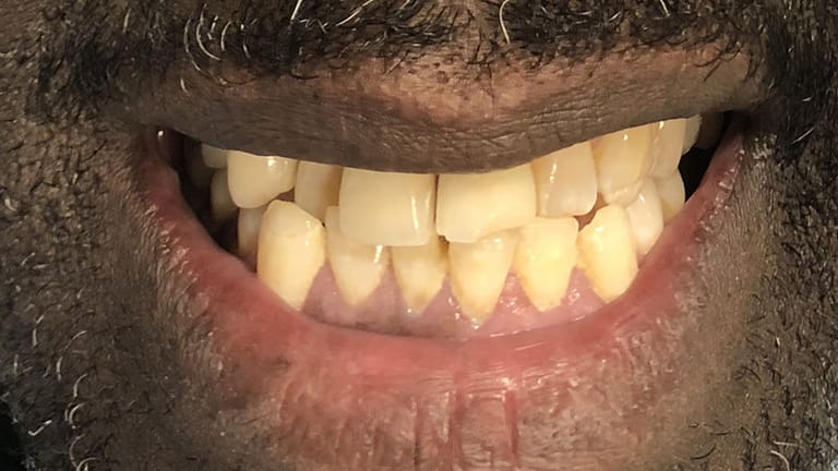 Before Life-Like Crown Benefits