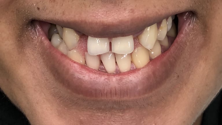 Before Life-Like Crown Benefits