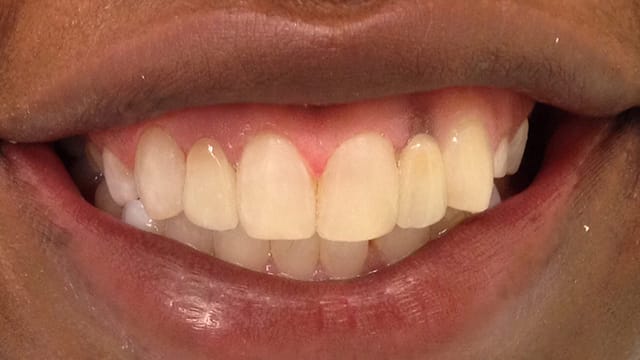 After Dental Implants Benefits