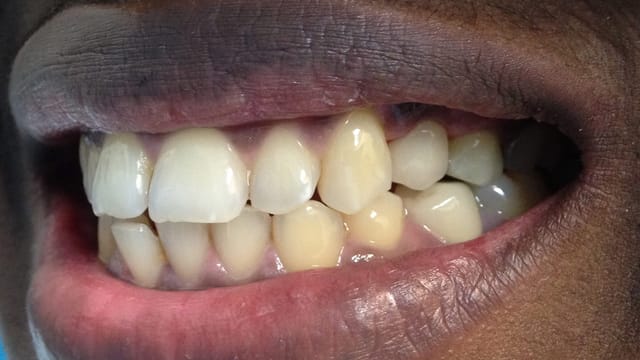 After Dental Implants Benefits