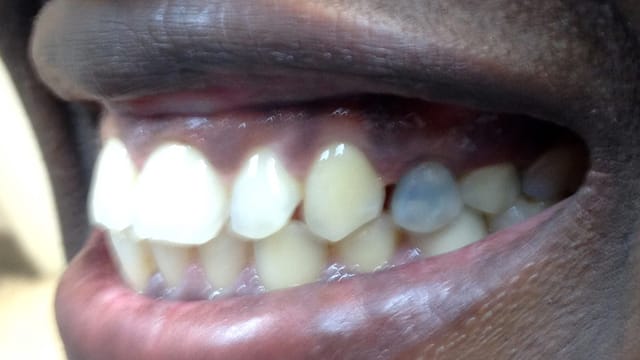 Before Dental Implant Benefits