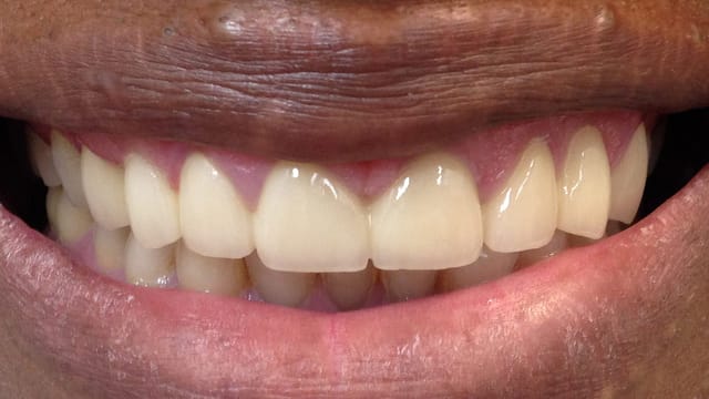 After Dental Implnats Benefits