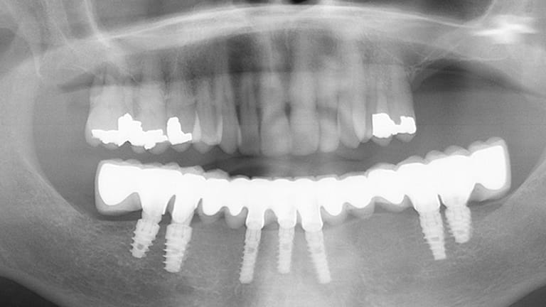 After Dental Implnats Benefits