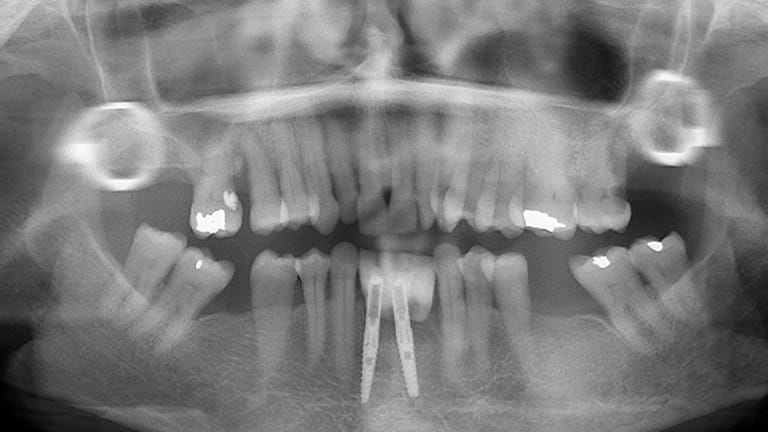 Before Dental Implant Benefits