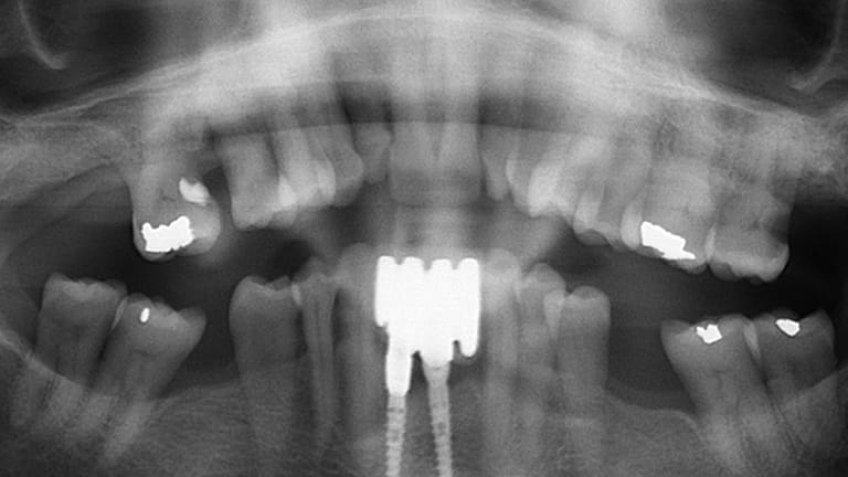 Before Dental Implant Benefits