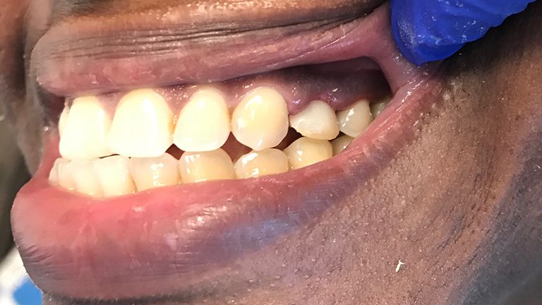 After New Smile Benefits