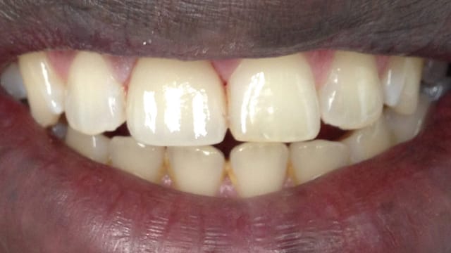 After Invisalign Benefits