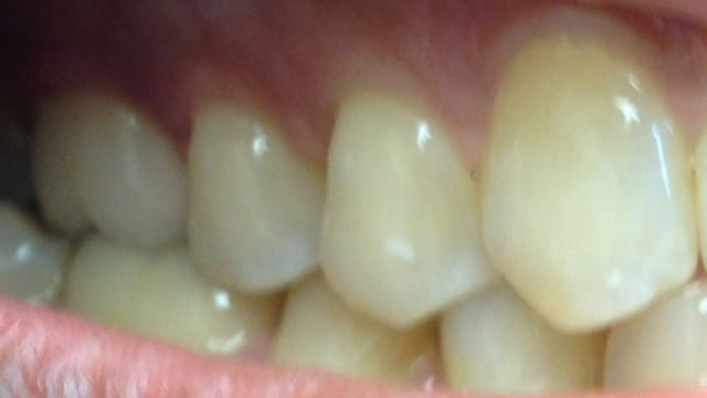 After Invisalign Benefits