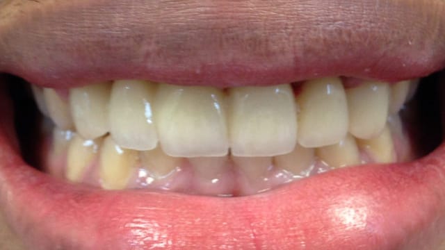 After Invisalign Benefits