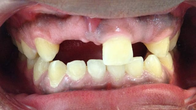 Before Life-Like Crown Benefits