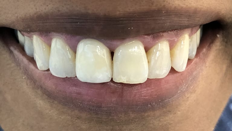 After Crown Zirconia Benefits