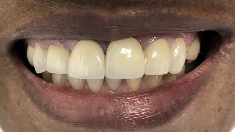 Before Life-Like Crown Benefits