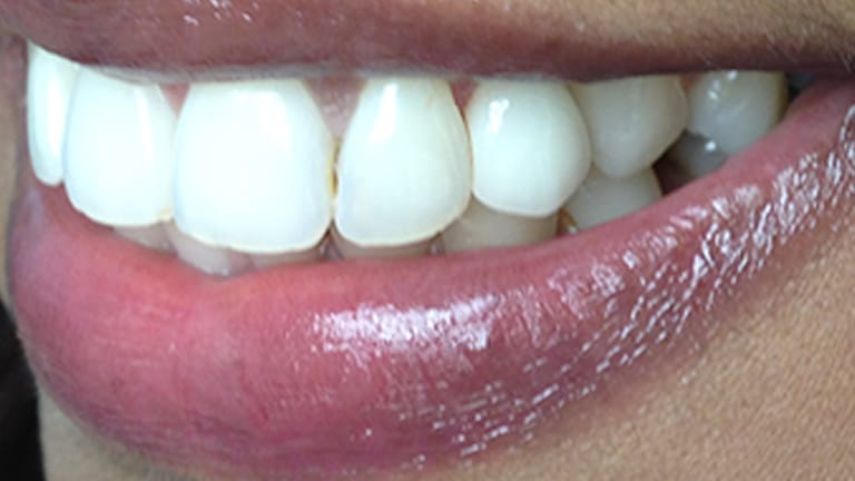 Before Dental Implant Benefits