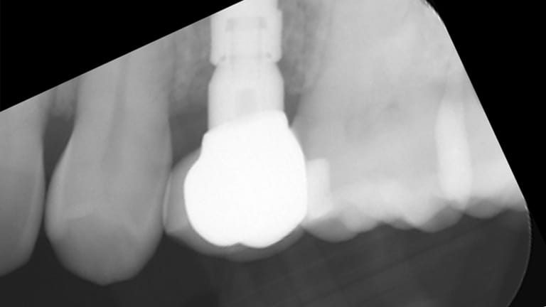 Before Dental Implant Benefits