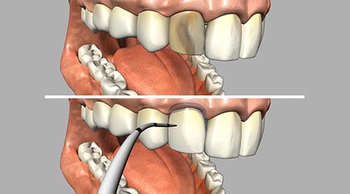 Dental Veneers